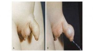 chữa trị viêm bao quy đầu ở trẻ em