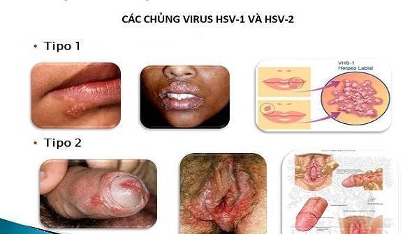 Bệnh mụn rộp sinh dục là gì?