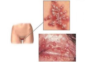 Bệnh mụn rộp sinh dục là gì?