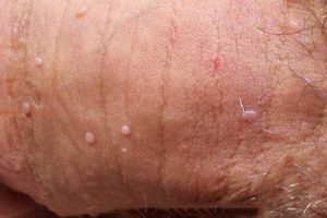 Bệnh mụn rộp sinh dục là gì?